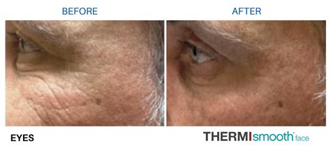 56 ThermiSmooth Face doctors & clinics in Alpharetta, GA.